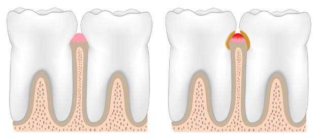 nov-gum-disease