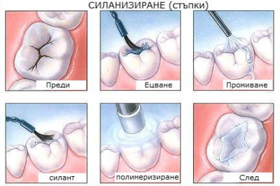 silanizirane_stypki
